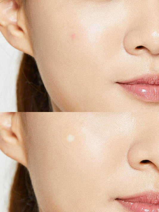 COSRX Patchs anti-acné